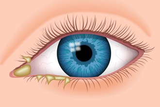 Eye with discharge