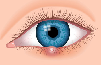 Eye with growth
