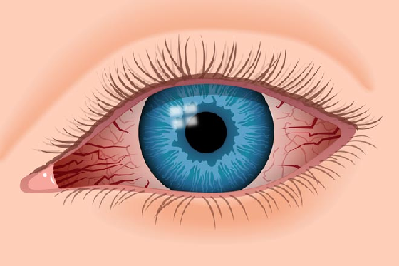 Itchy red eyes
