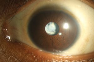 Close up of an eye that is white in the centre