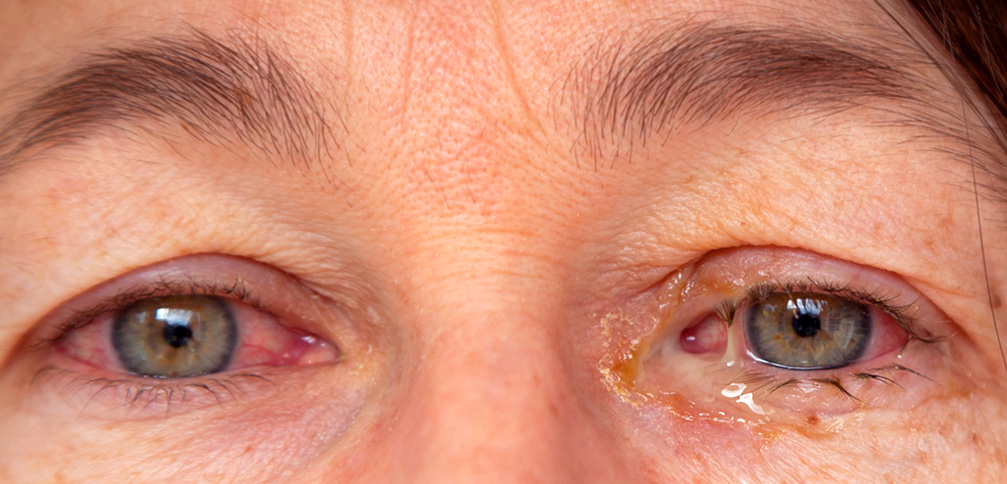 Two eyes looking straight ahead. They are red and there is watery discharge from the left eye.