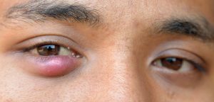 Two eyes, the one on the left has a red lump on the lower eyelid