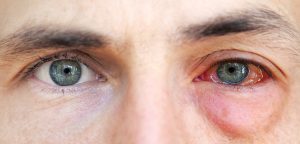 Two eyes, the eye on the right is very red and swollen