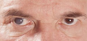 Two eyes, the eye on the left is cloudy
