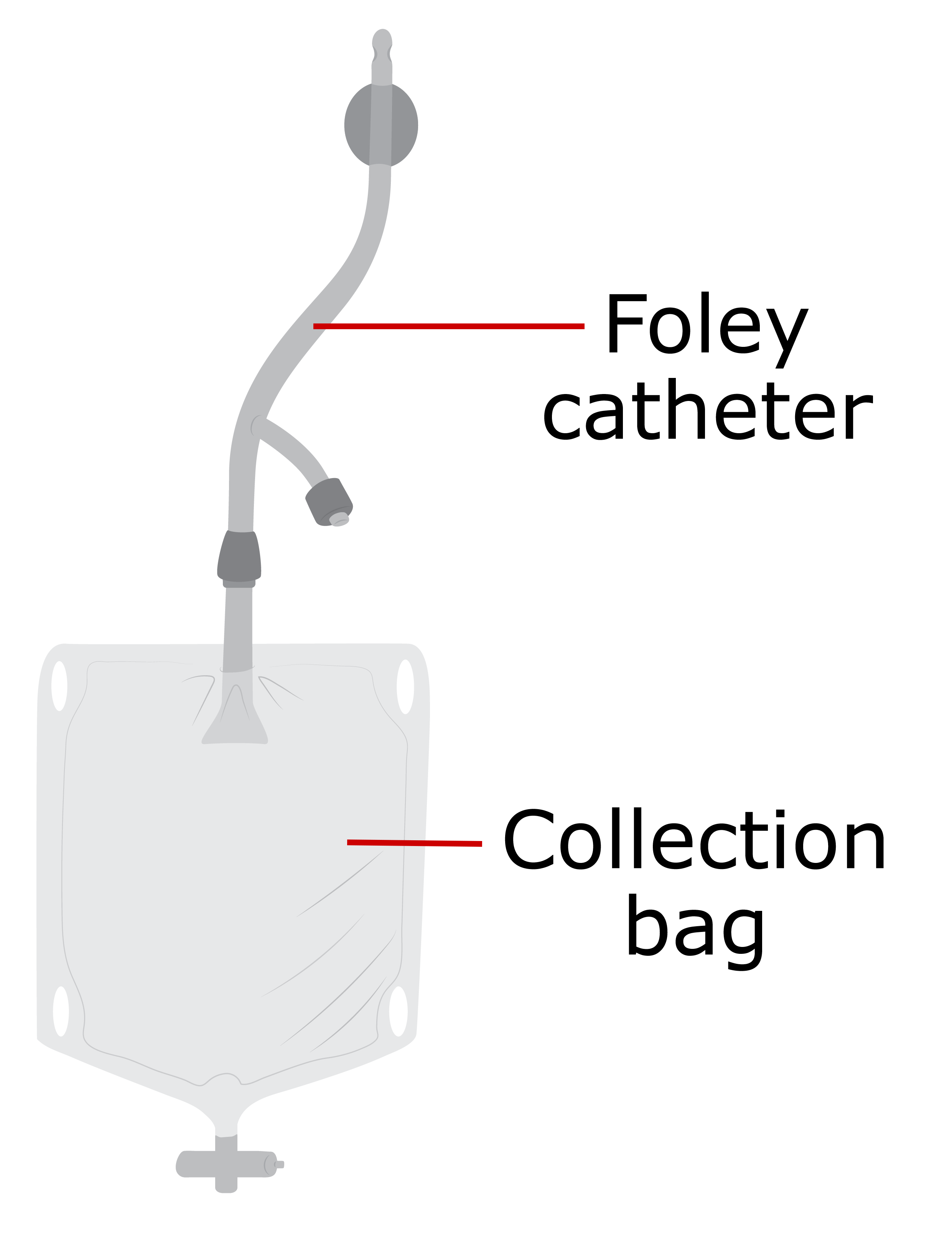 Foley catheter attached to a collection bag with a small tap at the bottom.