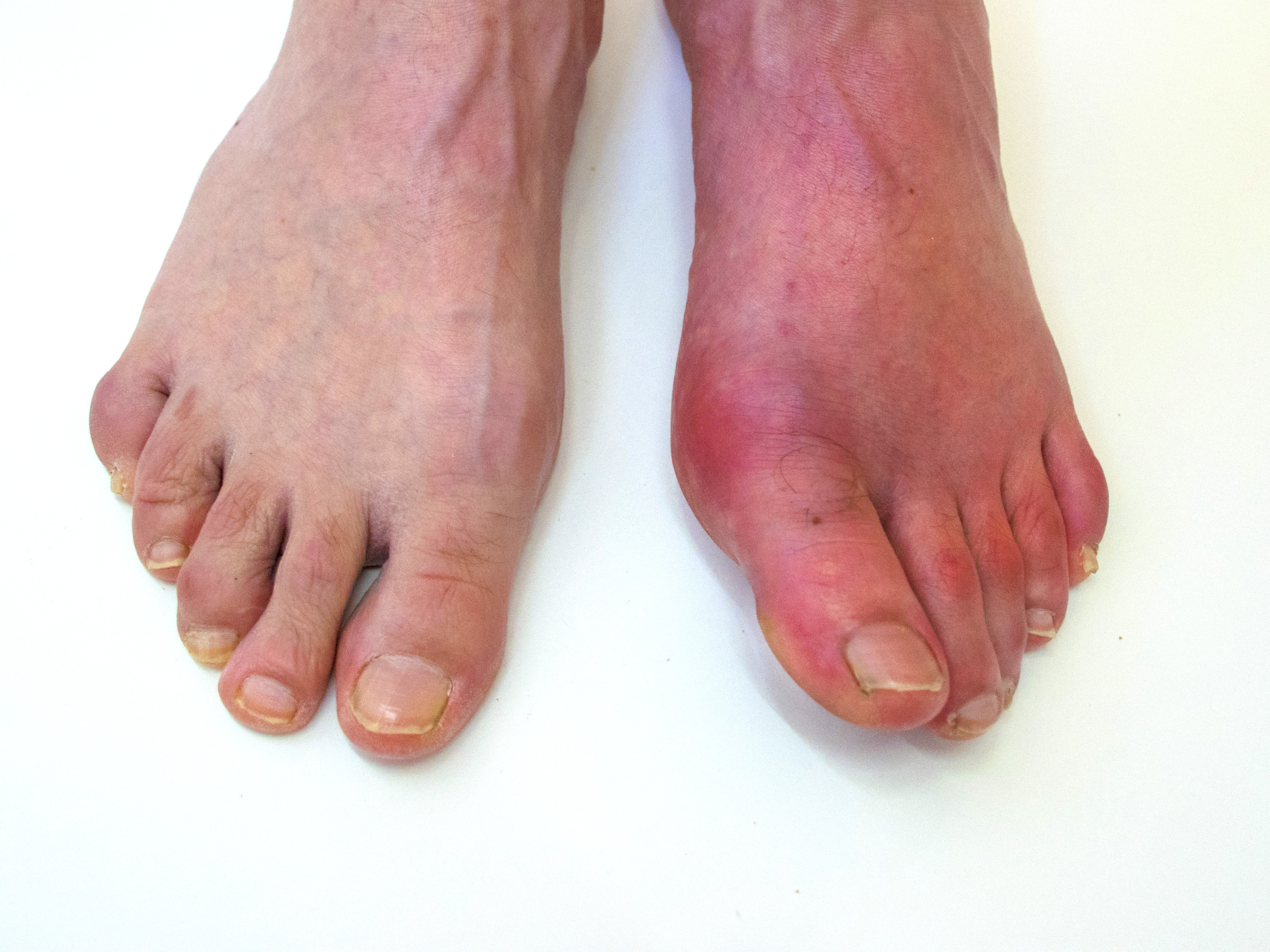 A person’s left foot is larger and more red that their right foot.