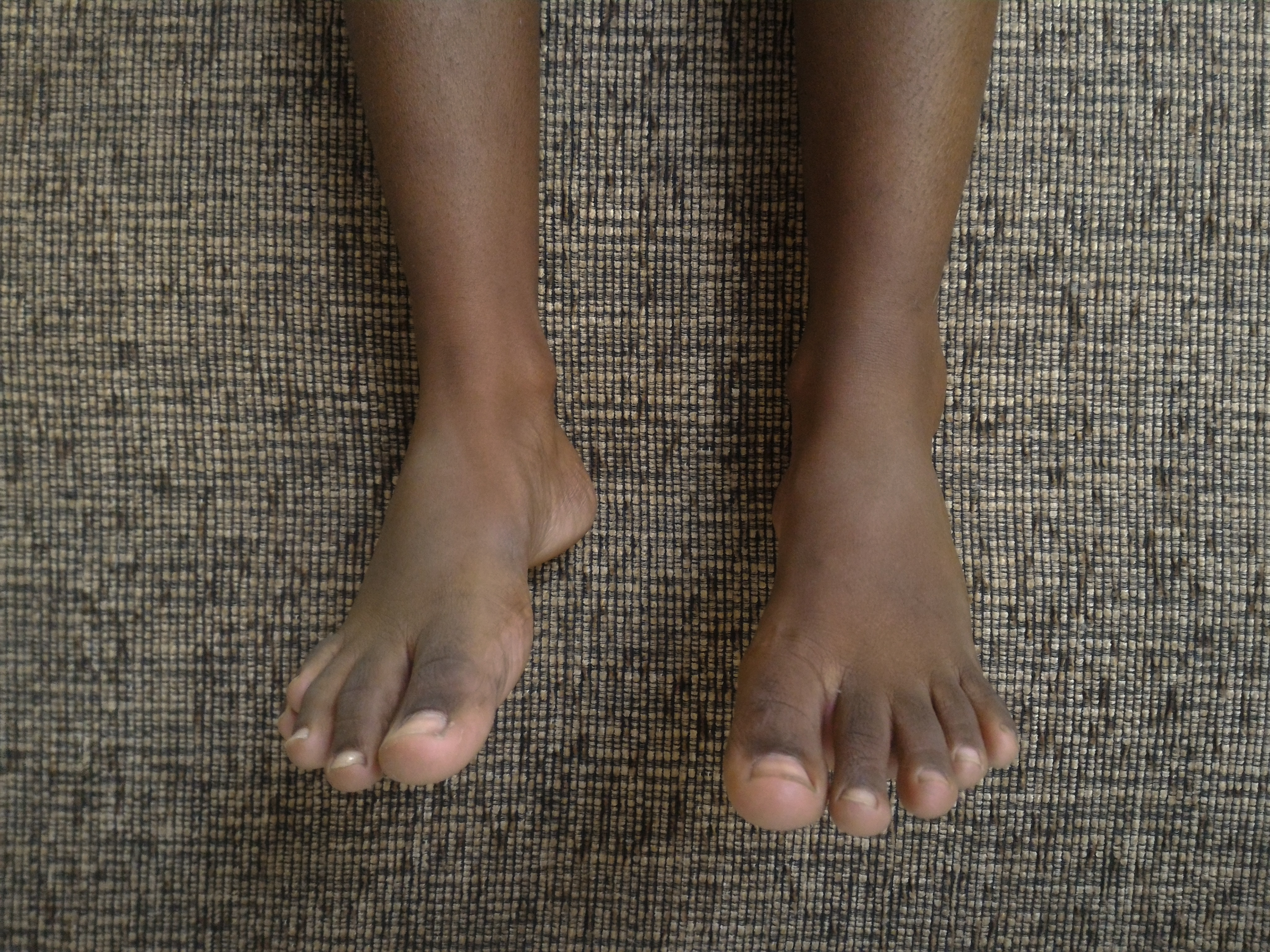 A pair of feet, the skin is smooth and unbroken, the toes are straight and there is no swelling or discolouration.