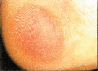 An area of skin on the heel of the foot is red.