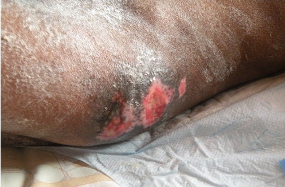 Small patches of skin have worn away and are red.