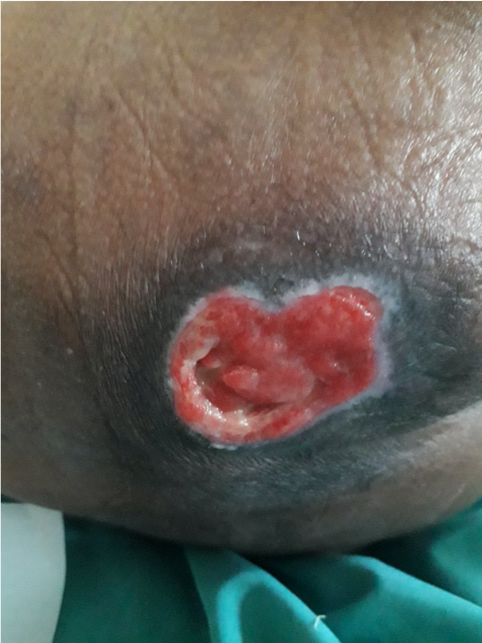 The full thickness of skin is lost leaving a deeper red wound.