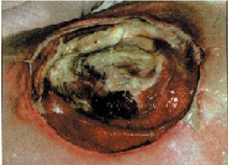 Very deep tissue damage. Colour ranges from red to black with infection.