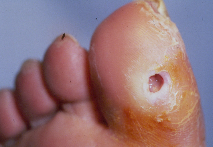 A wound in a toe revealing pink flesh and surrounded by cracked skin.