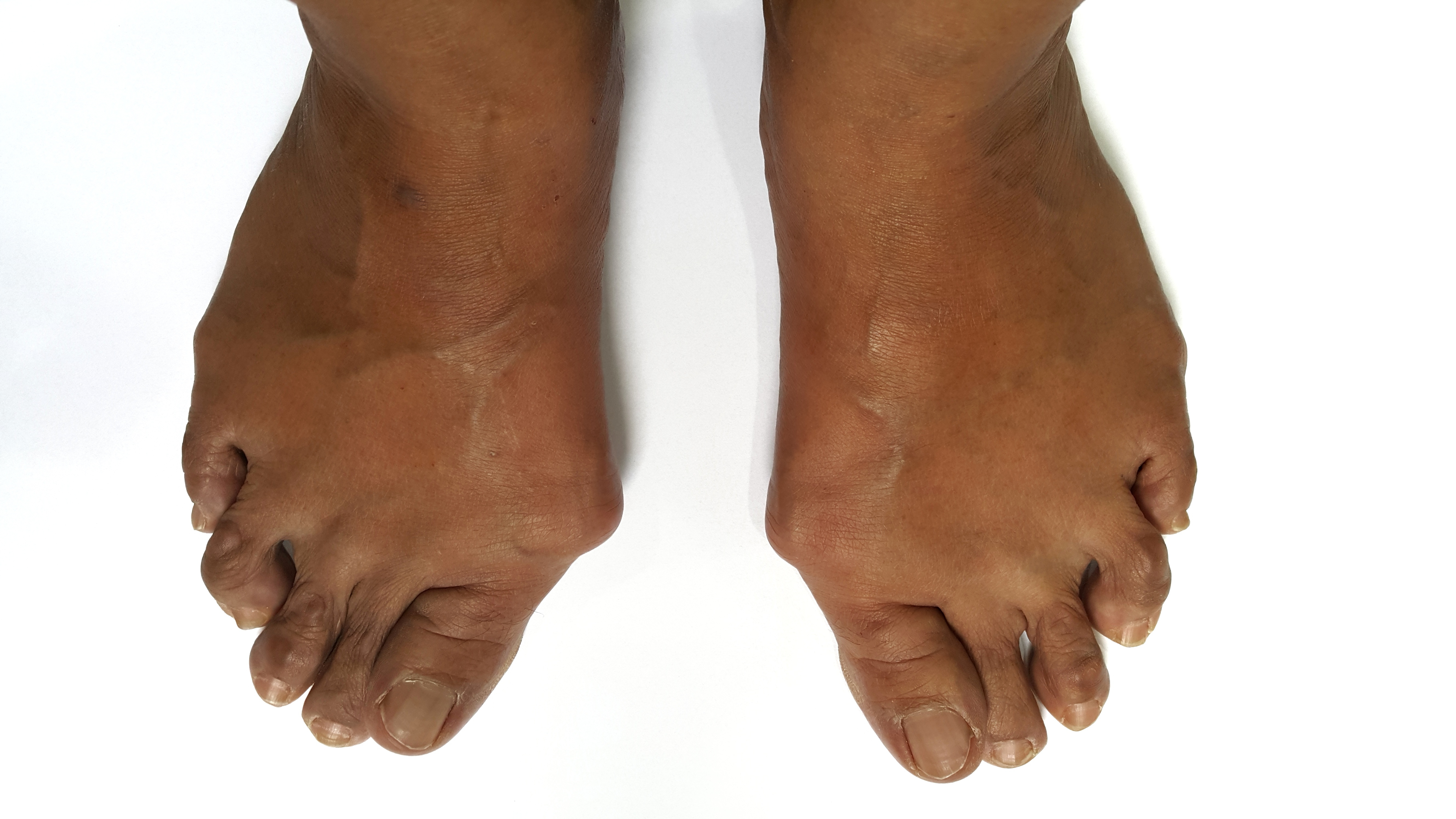 A pair of feet with a bump at the base of the big toe. The big toe has turned inwards towards the other toes.