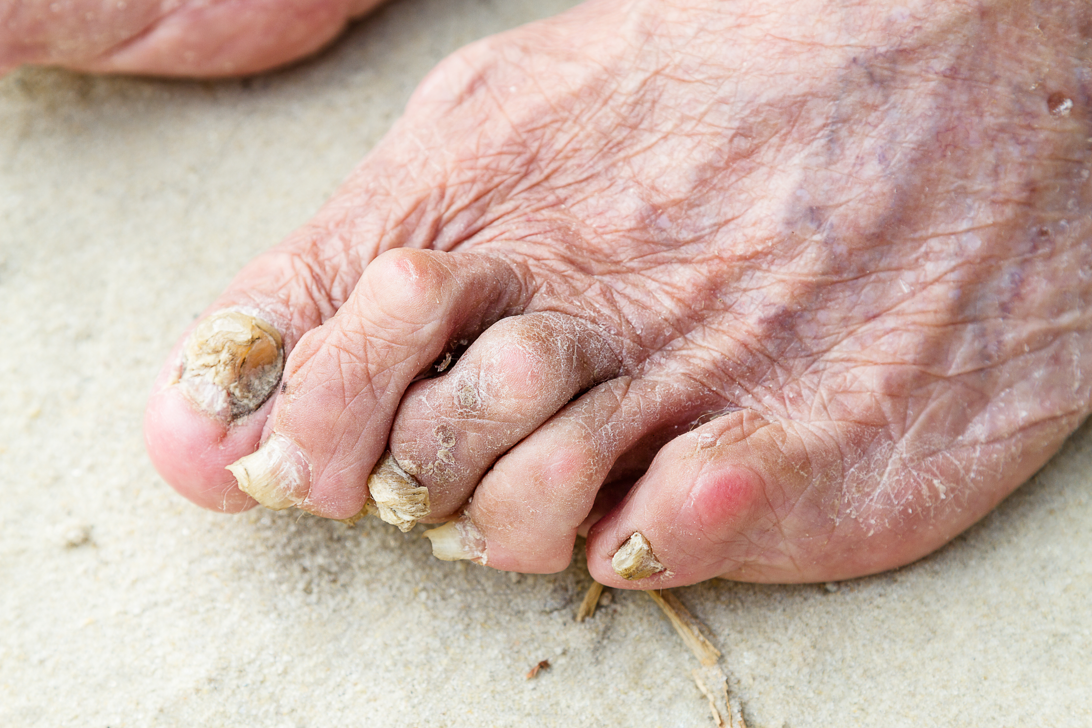 A foot with toes curled, nails dark and yellow and red and swollen joints of the toes.