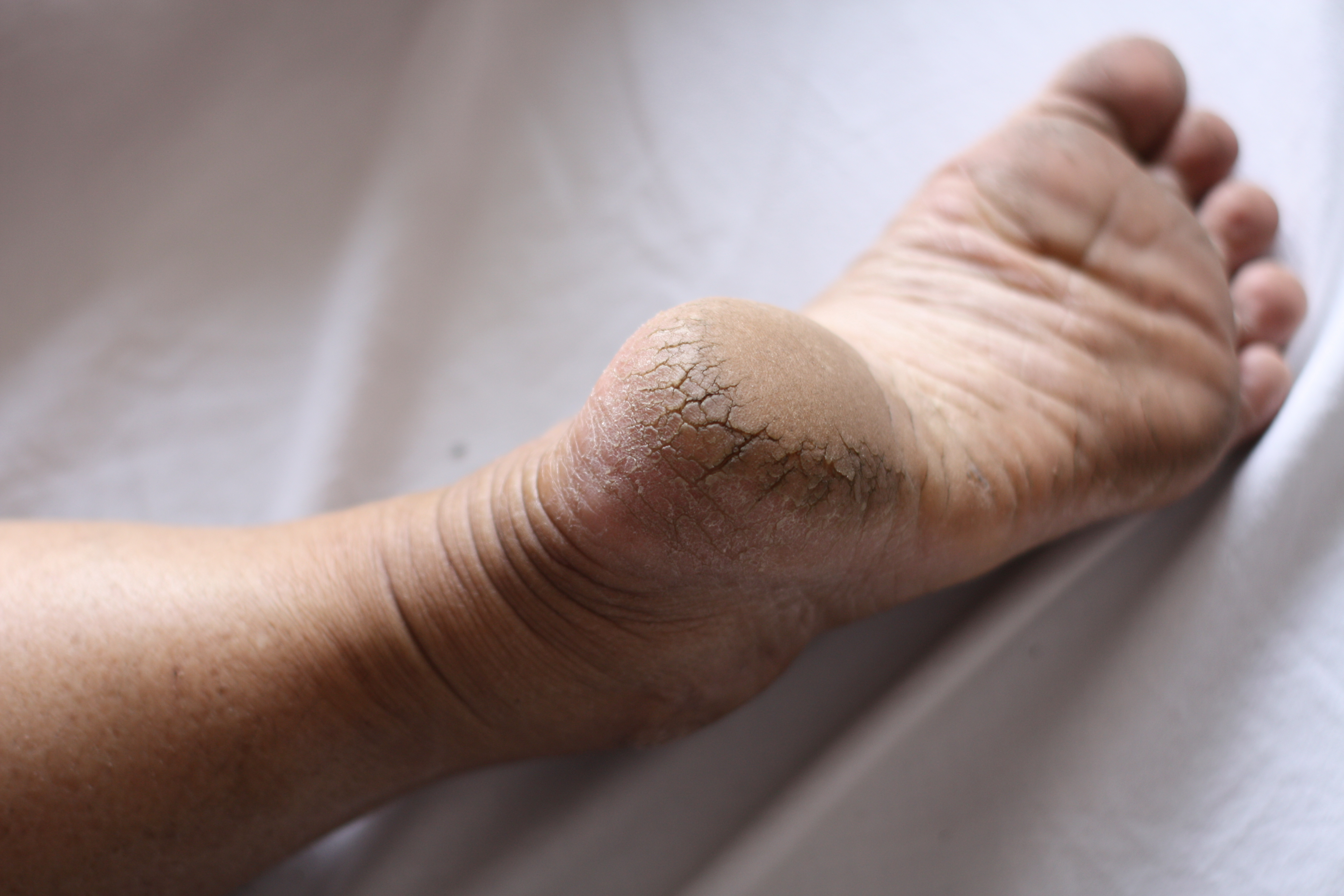 The bottom of a foot. The skin of the heel is cracked and dry.