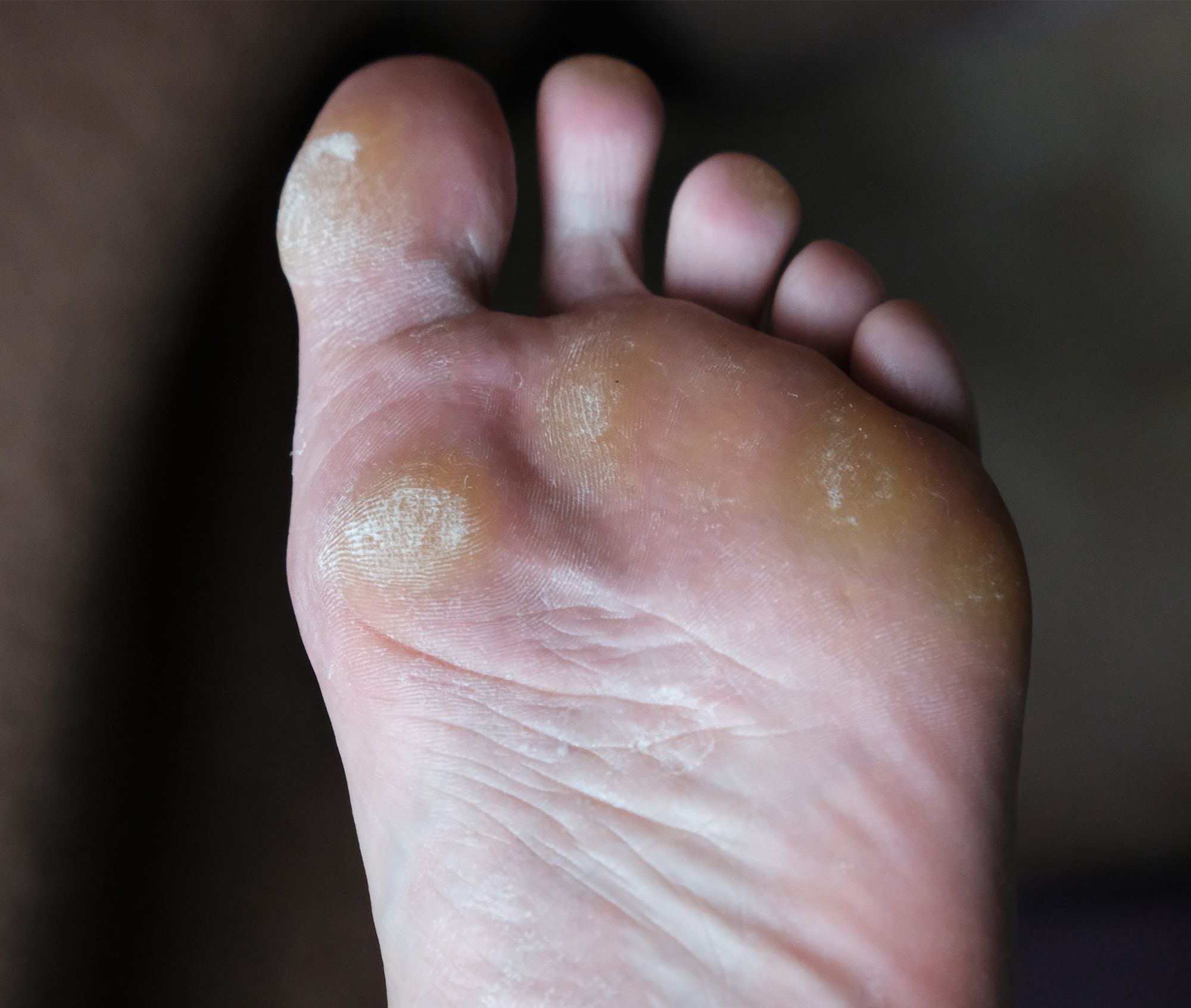 The bottom of a foot. The skin on the balls and toes in discoloured, thick and tough.