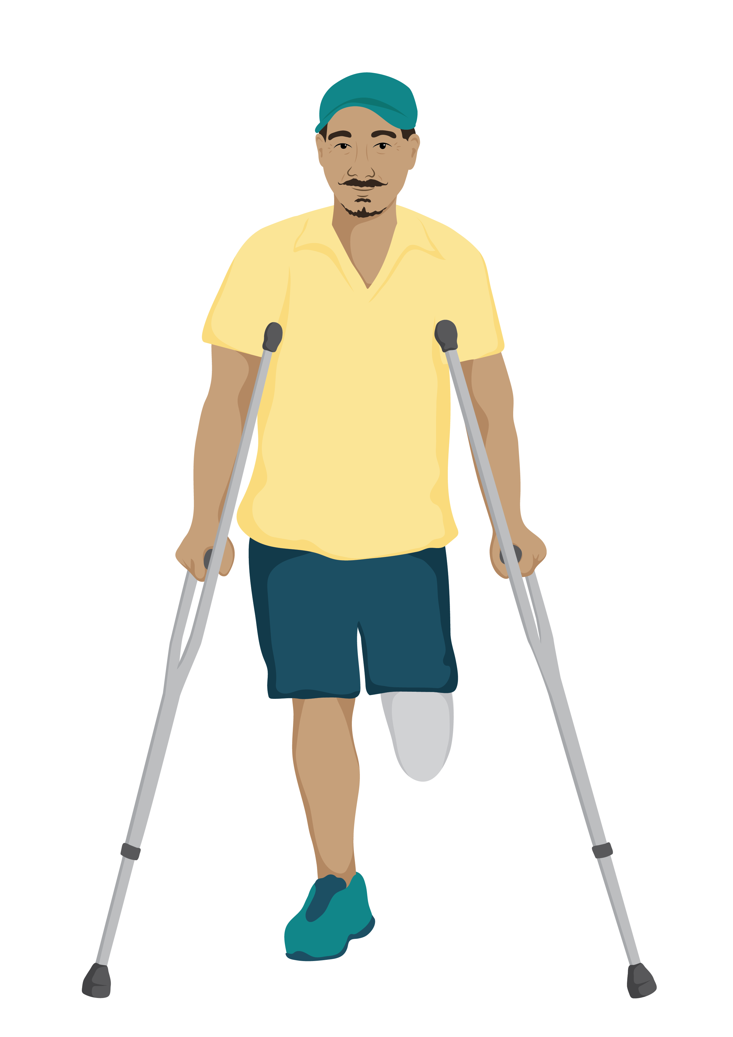 Dai is an older man with a below knee amputation and is using a pair of axilla crutches to stand.