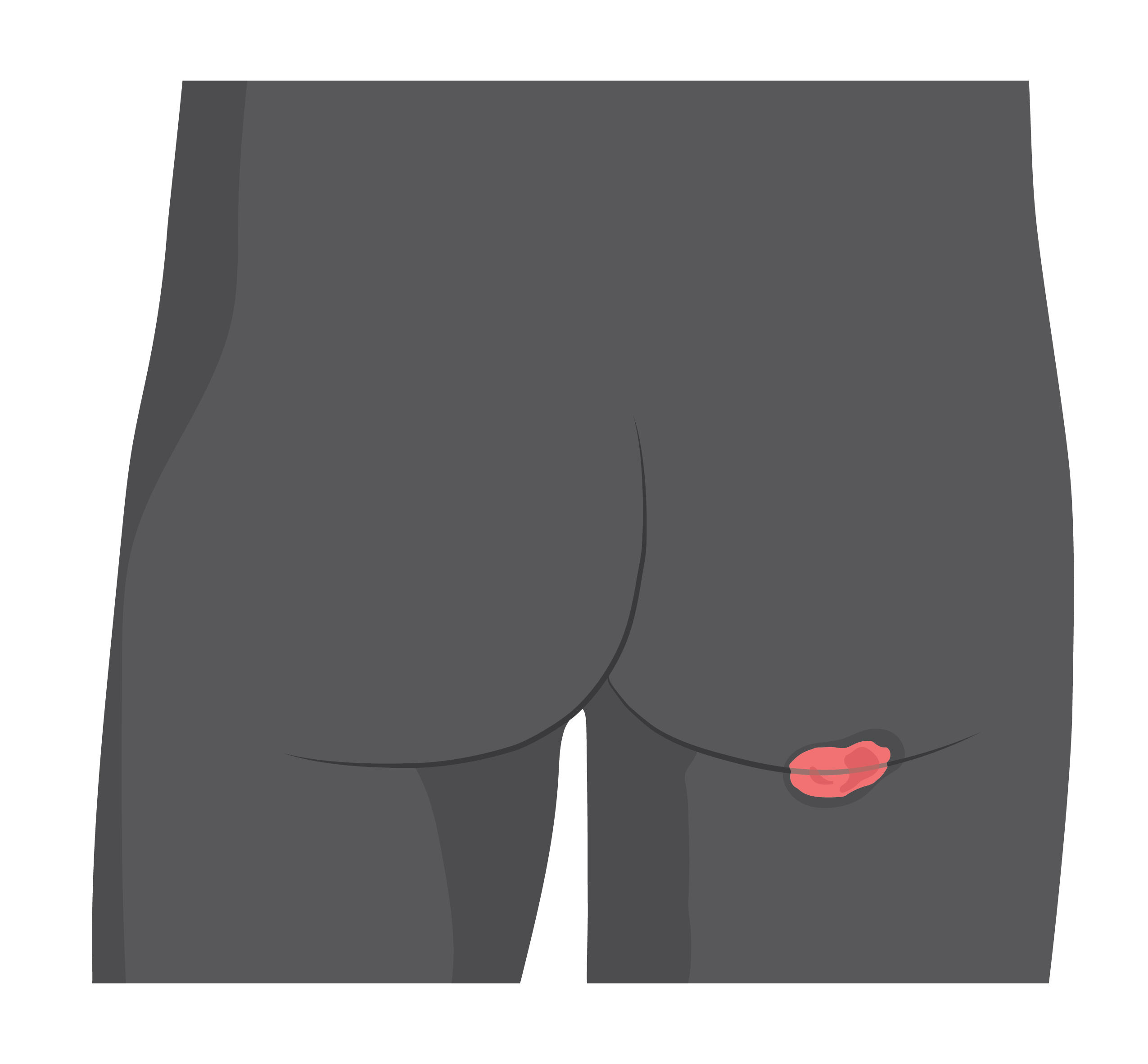 A small area where the bottom of a person’s buttocks meets the top of their thigh is red.