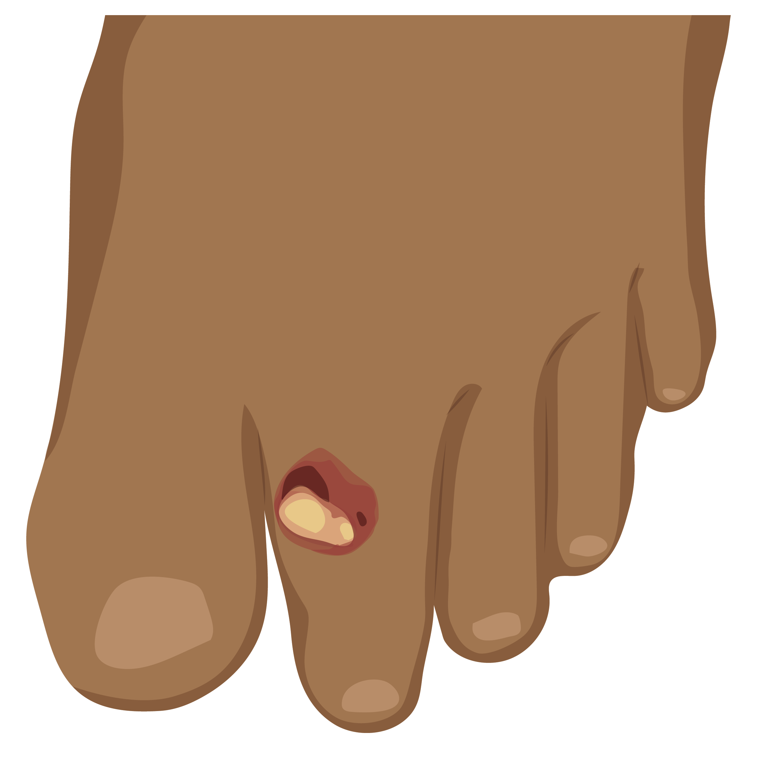 Foot with a wound on top of the second toe.