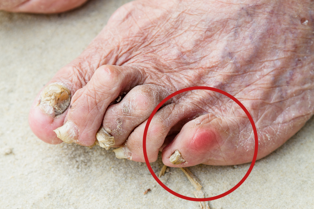 Foot of an older person with curled toes with a red mark on the top. The red mark is circled.