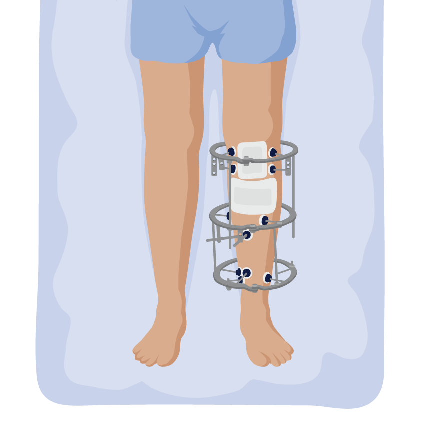 A metal device attached to a person's leg below the knee.