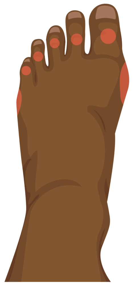 Top of foot showing pressure areas on top of toes and sides of the feet.