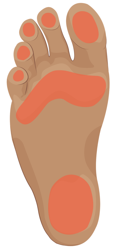 Bottom of foot showing pressure areas on bottom of toes, balls of feet and heel.
