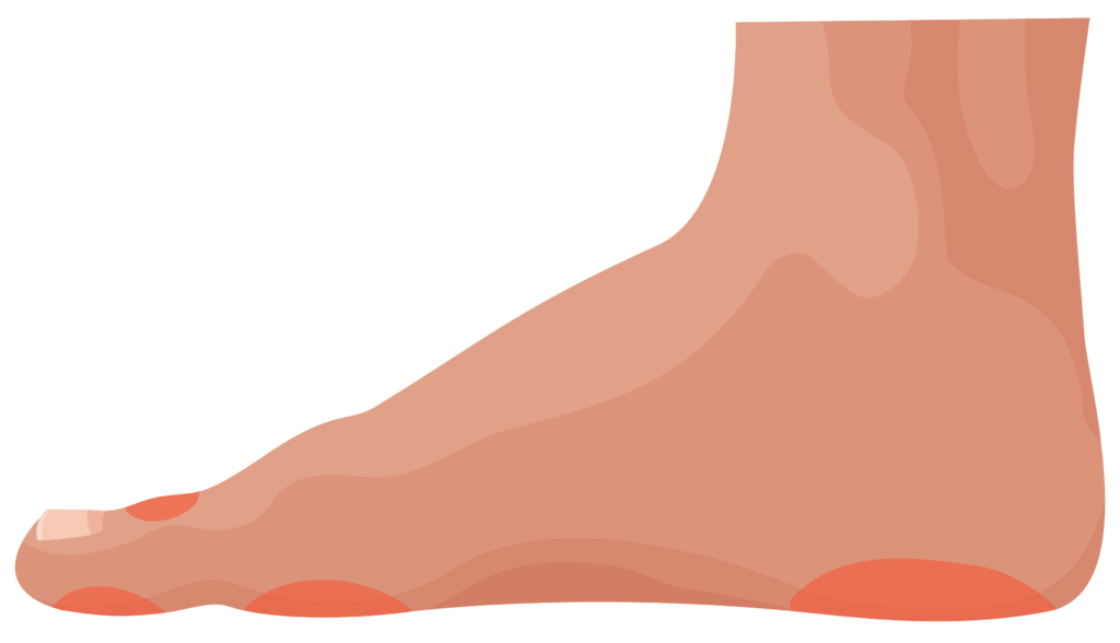 Side of foot showing pressure areas on top of toes, bottom of toes, balls of feet and heel.