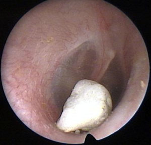 Foreign body inside person’s ear canal.