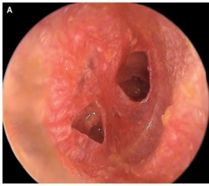 Person’s eardrum has two holes and is red and inflamed.