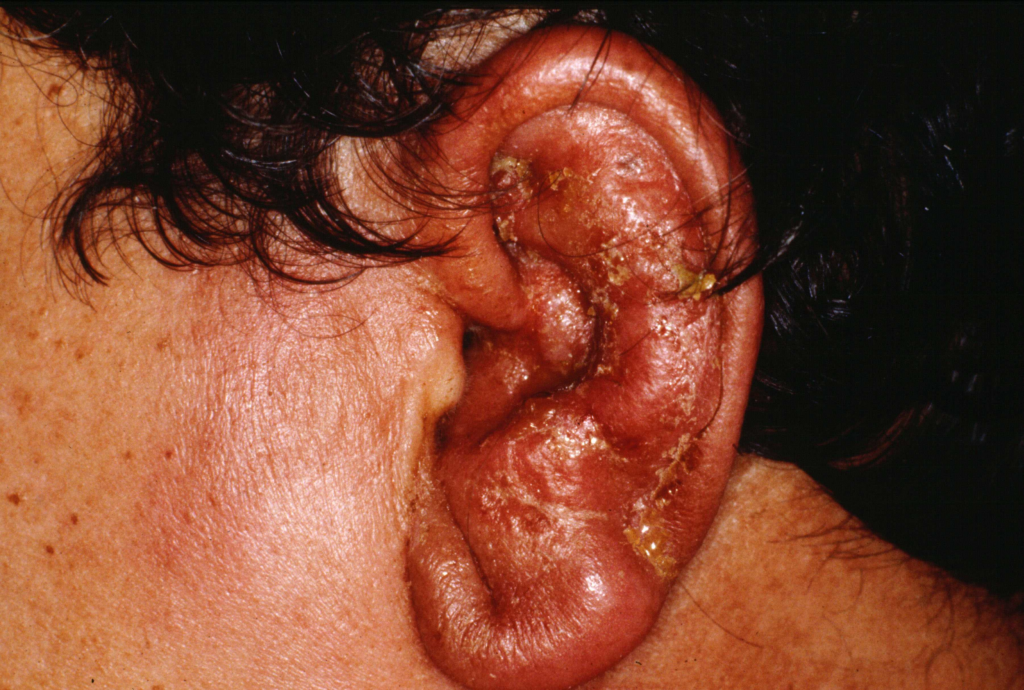 Person’s left pinna is infected and swollen.
