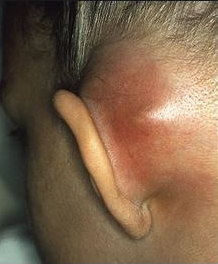 Person has swelling and a change in colour behind the ear.