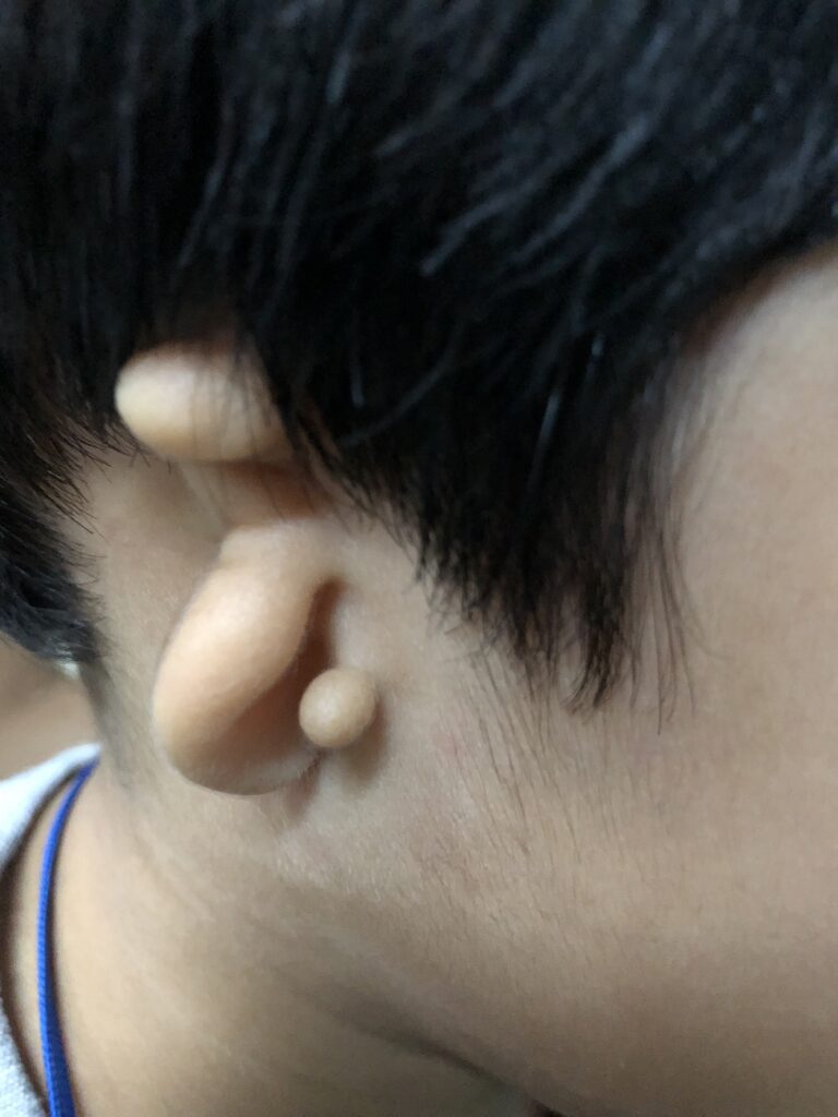 A pinna that is a very different shape. The ear canal is not obvious. There is no sign of injury or infection. 