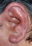Person’s ear pinna is swollen and red.