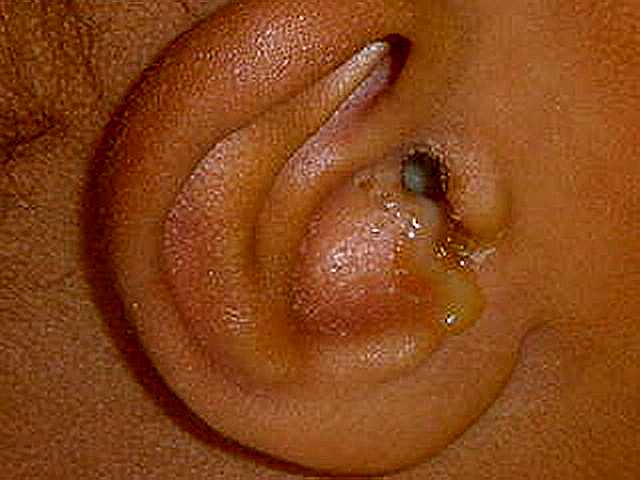 Coloured discharge is coming out of the ear.