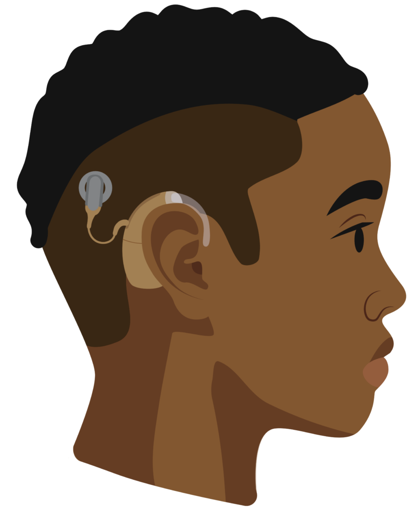 An outside piece sits behind the person’s ear and connects to a round head piece which attaches to the implant in their head.
