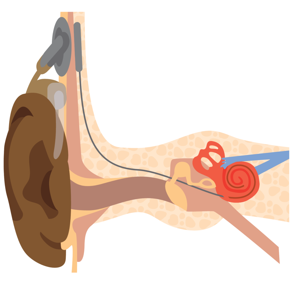 An inside piece picks up signals and passes them along a wire to the cochlea in the inner ear.