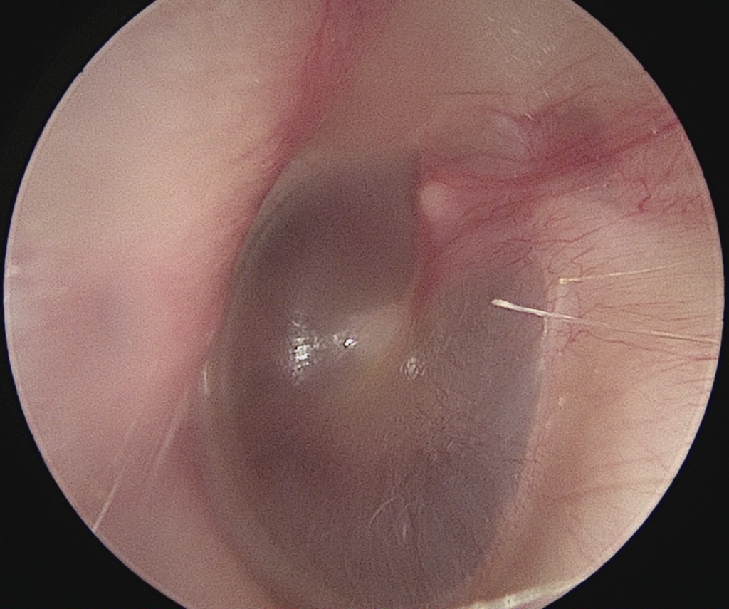 A person’s healthy ear canal and eardrum.