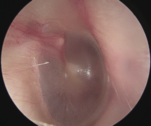 Person’s left ear canal is clear. The eardrum is clear and a white/light grey colour.