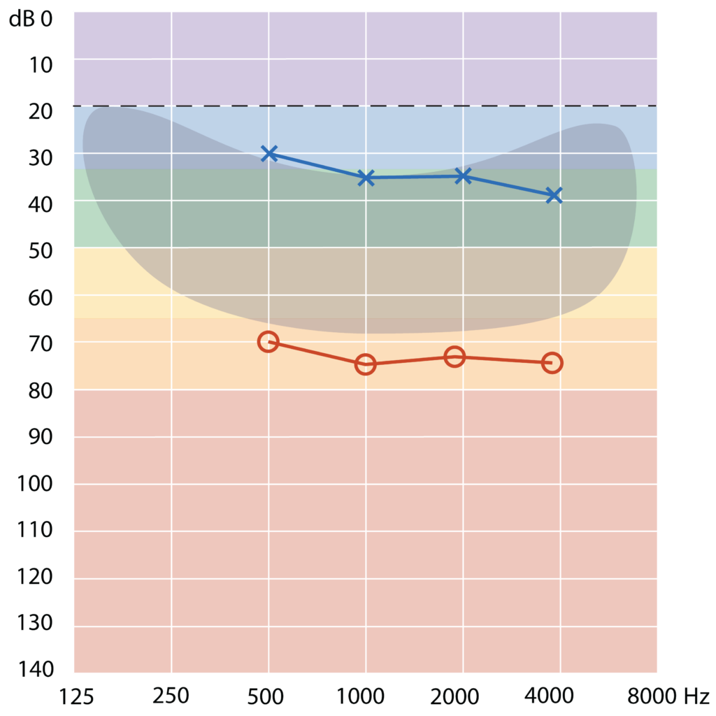 A graph showing an asymmetric hearing loss test result. The horizontal axis shows hertz (Hz), and the vertical axis shows decibels (dB). Left ear (marked by blue crosses) shows mild hearing loss thresholds for 500 Hz – 4000 Hz. Right ear (marked by red circles) shows severe hearing loss thresholds for 500Hz – 4000 Hz.