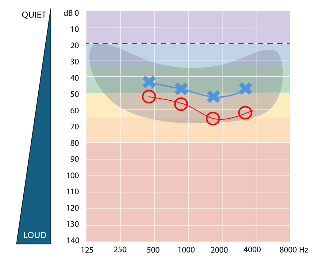 A graph of a person’s hearing test thresholds. Right ear (marked by red circles) and left ear (marked by blue crosses). The vertical axis shows sound level in decibels (dB) from 0 dB at the top down to the loudest level at 140 dB. Frequencies are on the horizontal axis from 125 Hz to 8000 Hz from left to right.