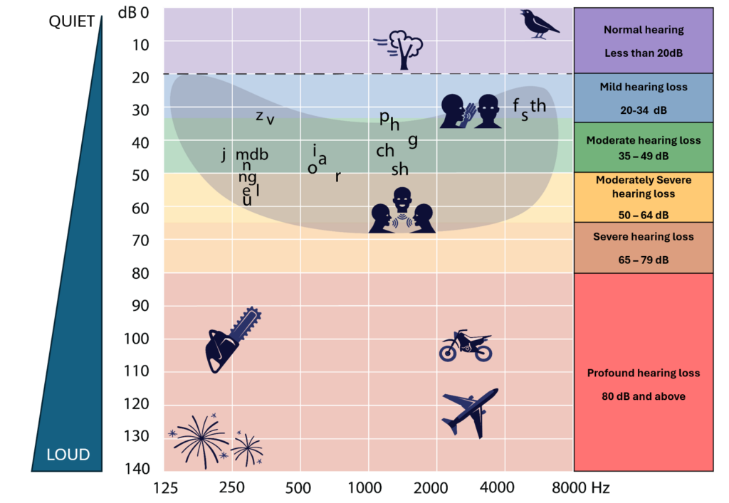 An audiogram graph showing grade of hearing loss on the right (bottom to top): • Profound hearing loss, 80 dB and above • Severe hearing loss, 65-79 dB • Moderately severe hearing loss 50-64 dB • Moderate hearing loss, 35-49 dB • Mild hearing loss, 20-34 dB • Normal hearing, less than 20 dB.
