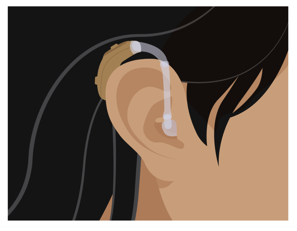 A person wearing a behind-the-ear hearing aid. The tube is long. The plastic case of the hearing aid is raised above and slightly behind the person’s ear.