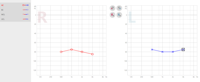 Computer programmable software screenshot with audiogram screen and hearing test thresholds. Right ear (marked by red circles) and left ear (marked by blue crosses).