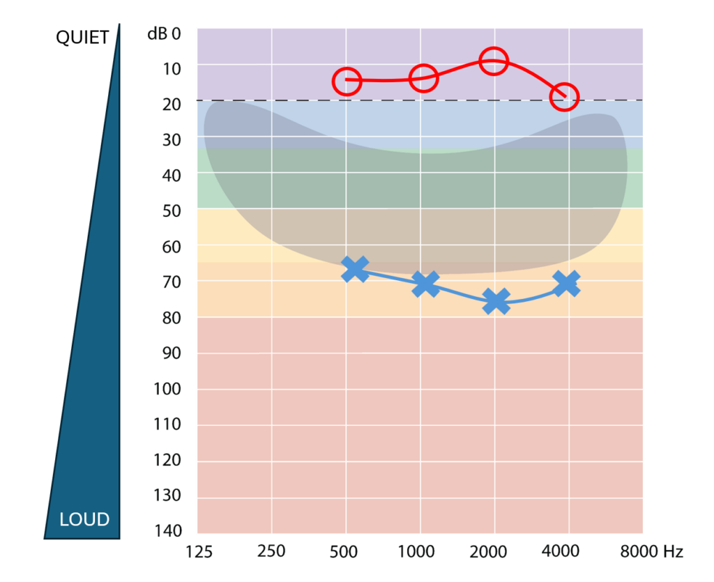 Hearing test result plotted on an audiogram. Right ear (marked by red circles) shows normal hearing thresholds for 500 Hz – 4000 Hz. Left ear marked in blue crosses) shows severe hearing loss thresholds for 500 Hz – 4000 Hz.