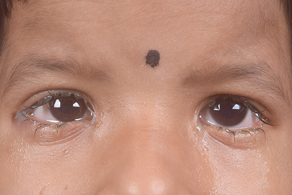 A child’s eyes. There is discharge around the eyelids.