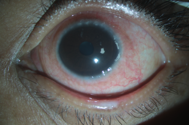 Cataract surgery - Mayo Clinic