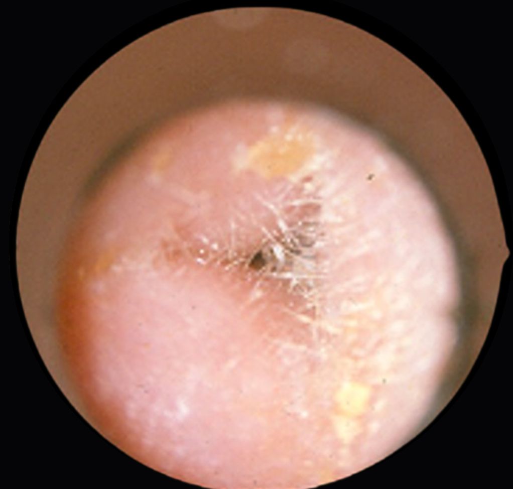 The inside of a person’s ear. The ear canal is red and almost fully blocked by swelling.