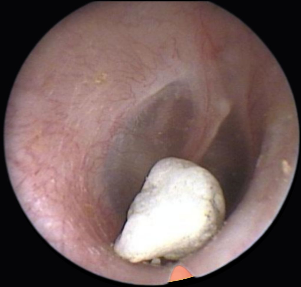 The inside of a person’s ear. There is a foreign body in the ear canal.