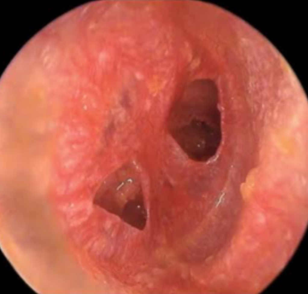 The inside of a person’s ear. The eardrum has two holes and is red and swollen.